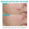 imageLa RochePosay Effaclar 15 Salicylic Acid Serum Acne Treatment For Face With Glycolic Acid ampamp Niacinamide Acne Serum Helps Clear Blackheads Whiteheads Pimples ampamp Reduces Post Acne MarksEffaclar Salicylic Acid Serum