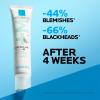 imageLa RochePosay Effaclar Salicylic Acid Acne Treatment For Face Mattifying Acne Gel Cream Spot Treatment for Blackheads Whiteheads ampamp Pores Prevents New Pimples NonGreasy Sensitive Skin SafeEffaclar Salicylic Acid Spot Treatment