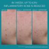 image:imageLa RochePosay Effaclar BPO MultiTarget Acne Treatment with 55 Micronized Benzoyl Peroxide Acne Cream for Face Targets Oily Skin Blackheads amp Prevents Pimples Dermatologist Recommended 20ml