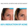 image:imageLa RochePosay Effaclar Dermatological 3 Step Acne Treatment System Salicylic Acid Acne Cleanser Pore Refining Toner and Benzoyl Peroxide Spot Treatment for Sensitive Skin